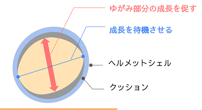 ヘルメット治療の原理